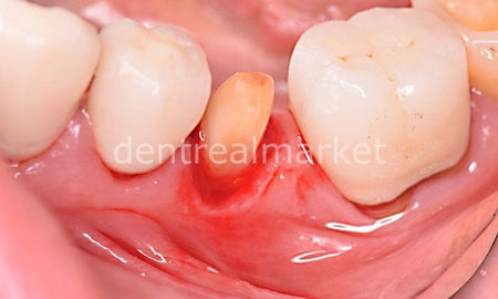 Sedenta Gingiva Gen Retraction Paste