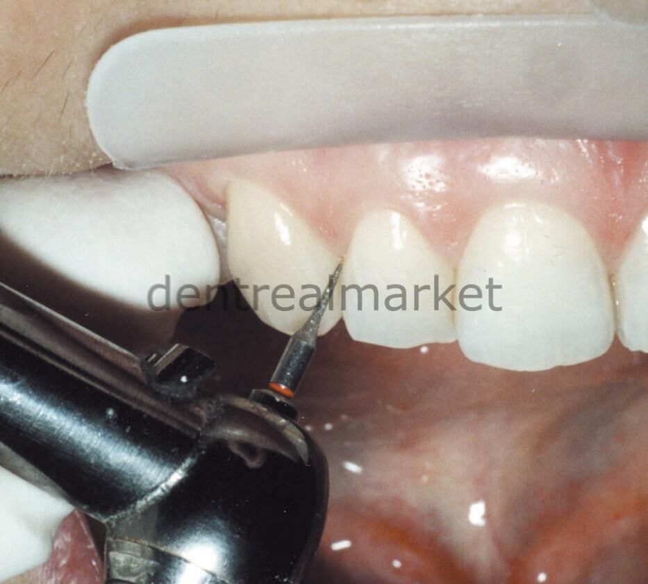 Frank Dental Orthodontic IPR Bur 392L - Interproximal Bur
