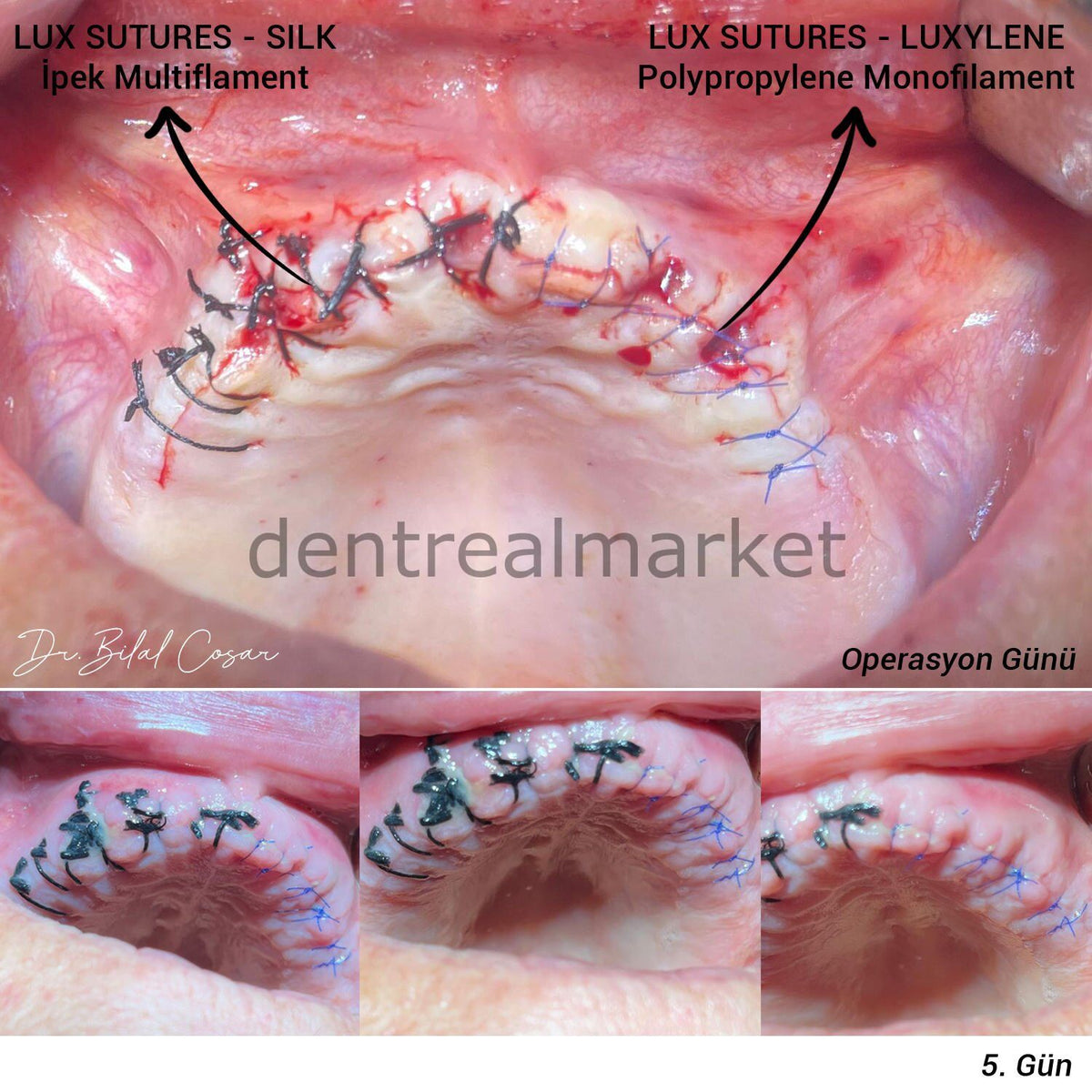 Lüx Sutures Luxylene Polypropylene Monofilament Surgical Suture — Reverse Cutting