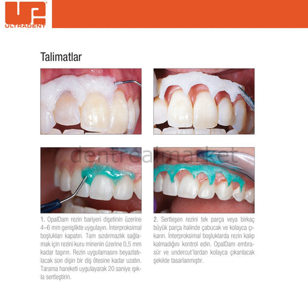 Ultradent OpalDam Green Kit - Gingival Protective Barrier