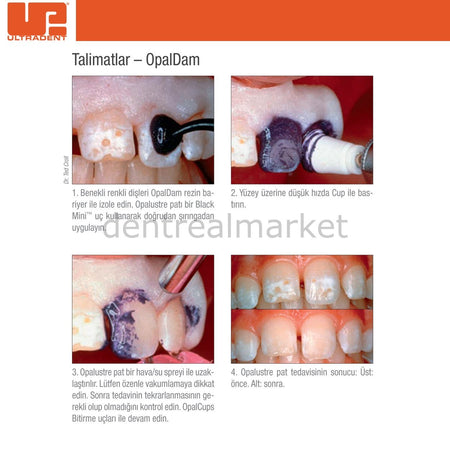 Ultradent Opalustre Whitening for Fluorosis-Stained Teeth, Pack of 2