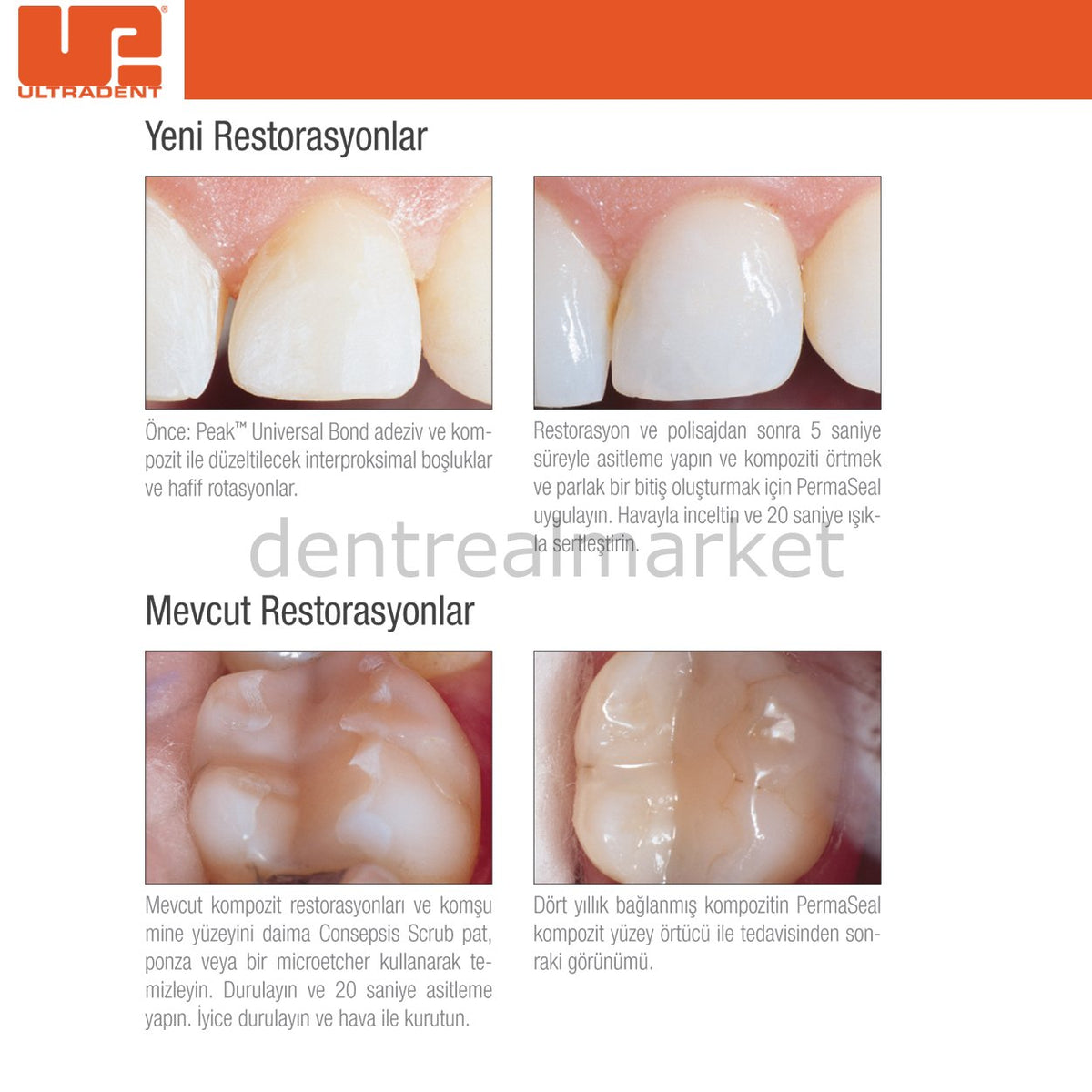 Ultradent PermaSeal Mini Kit - Composite Surface Sealant