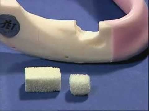 Maxxeus Block Bone Graft — 1 x 1 x 3 cm