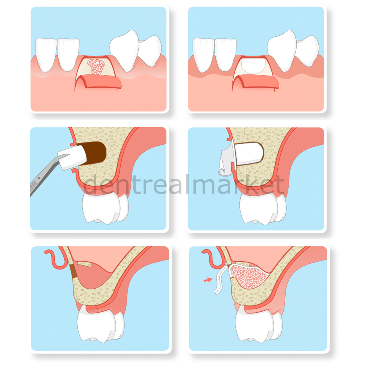 Resorba Parasorb Resodont Forte - Collagen Membrane 25*22 mm