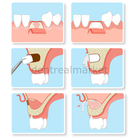 Resorba Parasorb Resodont Forte - Collagen Membrane 25*22 mm
