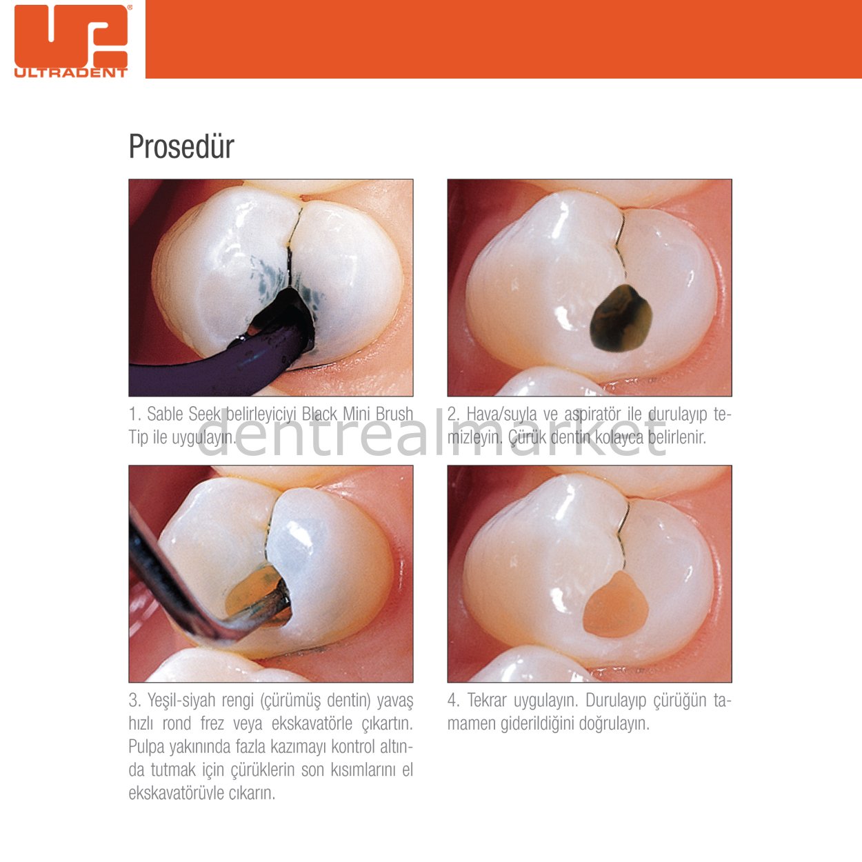 Ultradent Sable Seek Econo Caries Indicator Refill