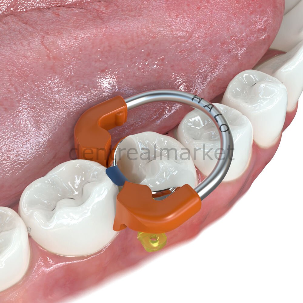 Ultradent Halo Universal Molar Ring